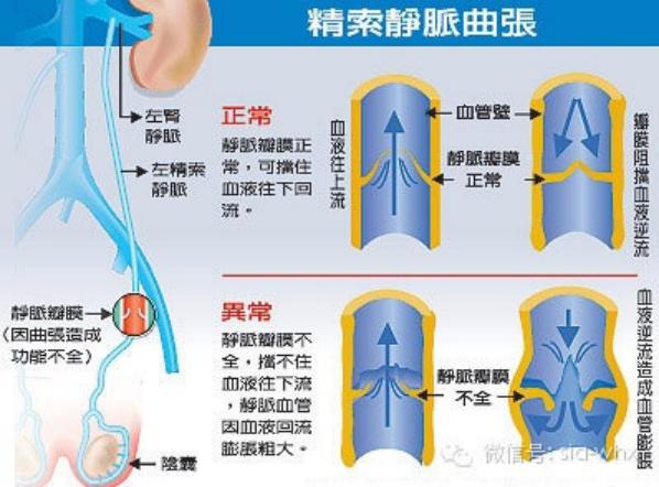 關(guān)于2021年征兵精索靜脈曲張標(biāo)準(zhǔn)的探討，2021年征兵精索靜脈曲張標(biāo)準(zhǔn)深度解析