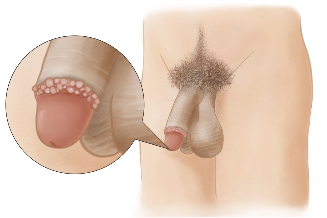 五分鐘教你識別珍珠疹，五分鐘學(xué)會識別珍珠疹的方法