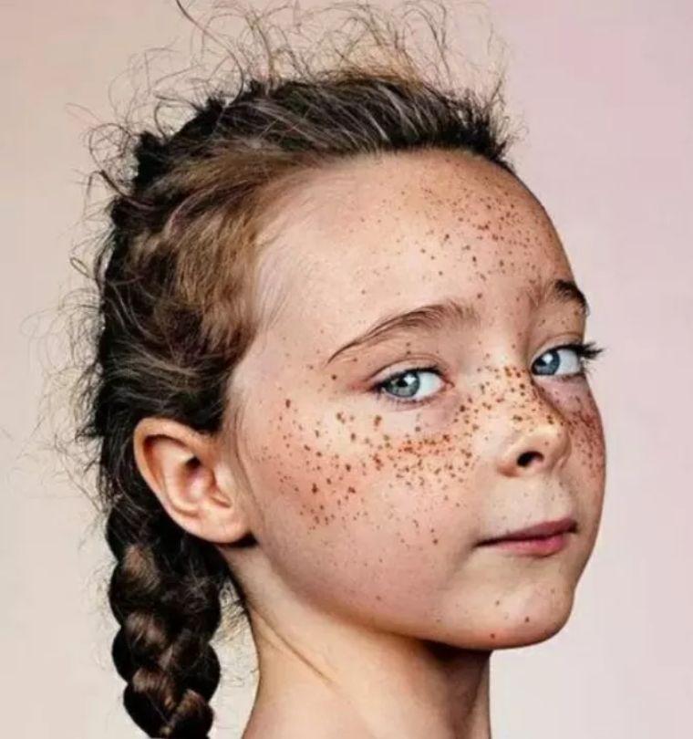 重度痤瘡小偏方