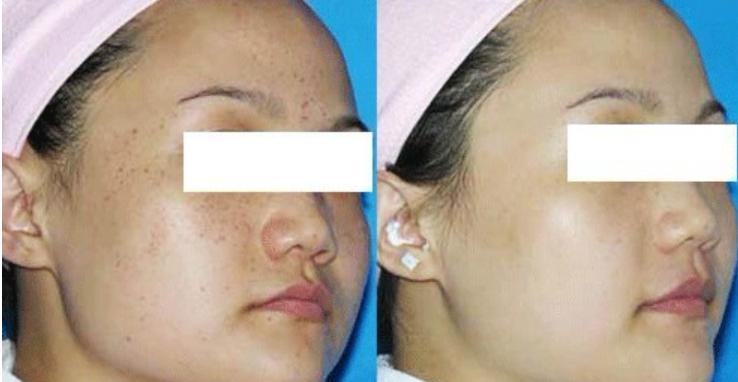 激光祛斑后需要注意的五大事項，激光祛斑后的五大注意事項詳解