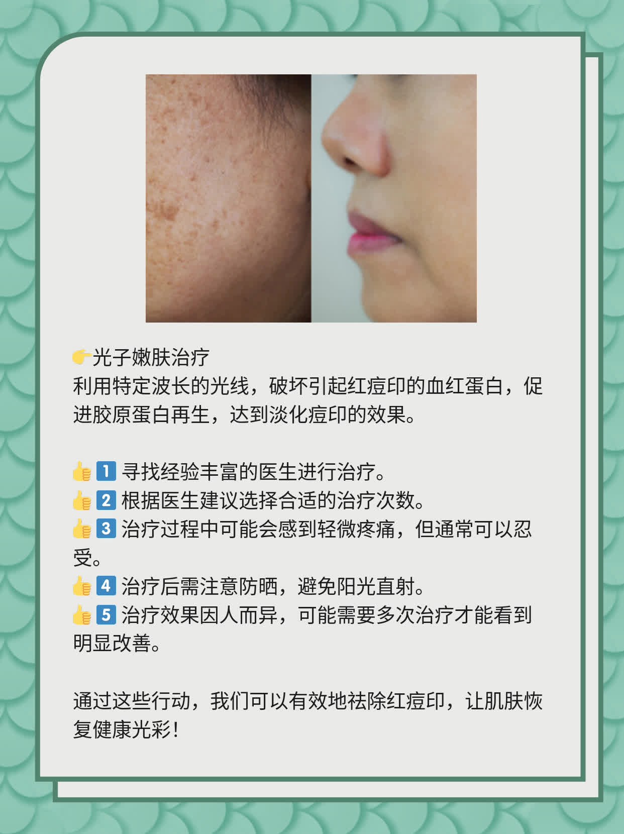 如何有效去除紅痘印，一站式解決方案，一站式解決紅痘印問(wèn)題，有效去除方法大全