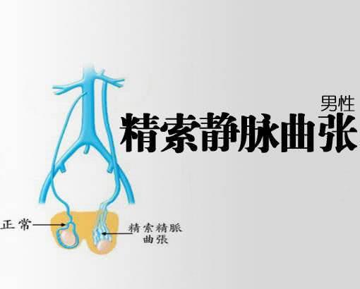 精索靜脈曲張的癥狀表現(xiàn)及其影響,精索靜脈曲張的癥狀表現(xiàn)及其潛在影響