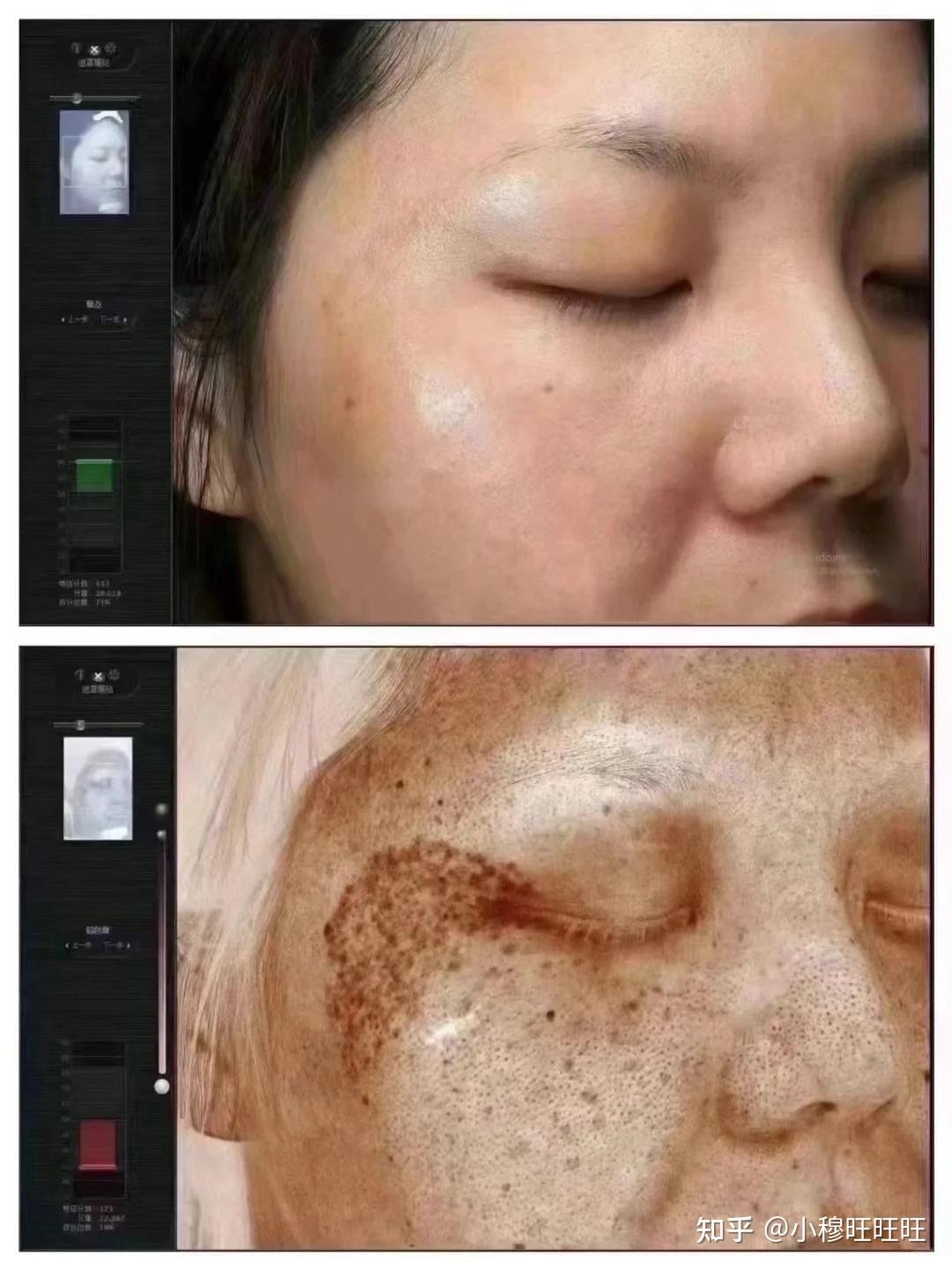 激光祛斑，選擇醫(yī)院還是美容院？全面解讀助您做出明智決策，激光祛斑，如何選擇醫(yī)院與美容院？全面解讀為您指明決策方向