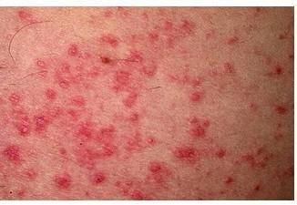 濕疹的七天演變過程圖片詳解，濕疹七天演變過程圖解，了解濕疹的演變之路