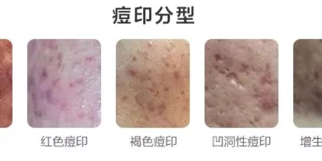 怎樣去痘印效果最好的方法，揭秘最佳去痘印方法，告別臉部瑕疵！