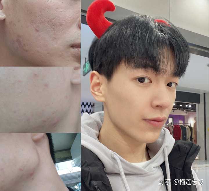 如何有效去除臉上的痘印——全方位指南，全方位指南，如何有效去除臉上痘印的方法